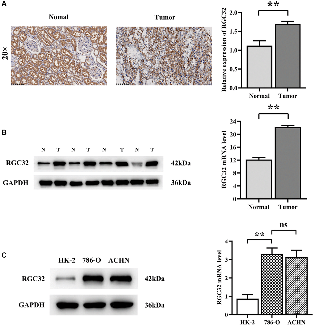 RGC32 protein expression in ccRCC and normal kidney tissue. (A) Immunohistochemical staining results of ccRCC tissues and normal renal tissues and RGC32 expression statistics; (B) Western blotting results of ccRCC tissues and normal kidney tissues, as well as RGC32 expression statistics; (C) Western blotting results of HK-2 cells, 786-O cells and ACHN cells and expression statistics of RGC32. **p nsp > 0.05.