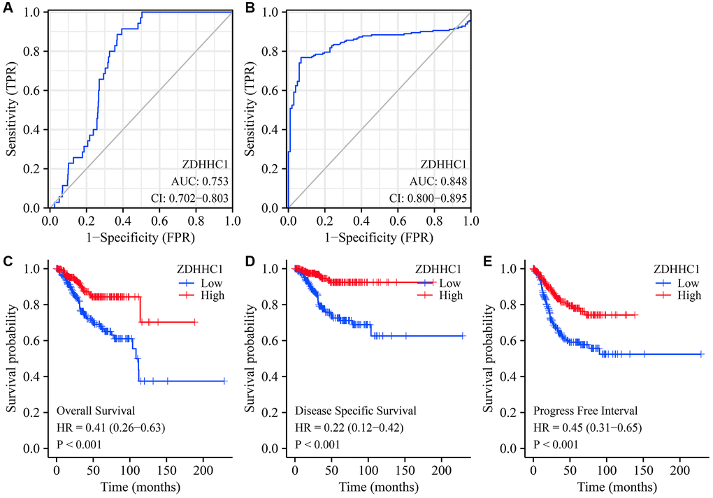 ZDHHC1 expression is related to diagnosis and prognosis in UCEC. (A, B) The diagnostic values of ZDHHC1 in UCEC obtained from TCGA and GTEx data in Xena database. (C–E) The prognostic values of ZDHHC1 in UCEC calculated from TCGA data. Abbreviations: UCEC: uterine corpus endometrial carcinoma; ZDHHC1: zinc finger DHHC-type containing 1; TCGA: The Cancer Genome Atlas; GTEx: Genotype-Tissue Expression.