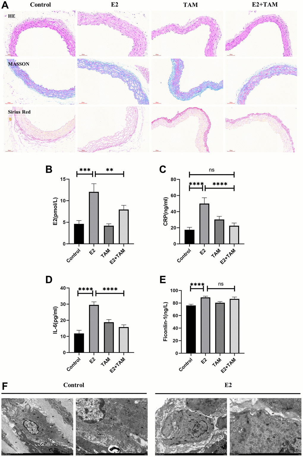 Detection of pathological changes in the aorta and serum inflammatory markers in mice. (A) The abdominal aorta was examined by pathology using HE, Masson’s trichome, and Picro-Sirius Red staining. (B–E) Peripheral blood of mice was taken and serum was centrifuged for analysis. E2, CRP, IL-6 and Ficonlin-1 levels were measured by ELISA. (F) The abdominal aorta of the model group was observed by TEM, which indicated slight swelling of organelles. The nucleus (N) was irregularly shaped and shrunken. Mitochondria (M) were abundant. The RER showed no obvious dilation and a large number of ribosomes attached to the surface. DPs and DBs were abundant and evenly distributed. Magnification 2500× and 7000×. **P ***P ****P 