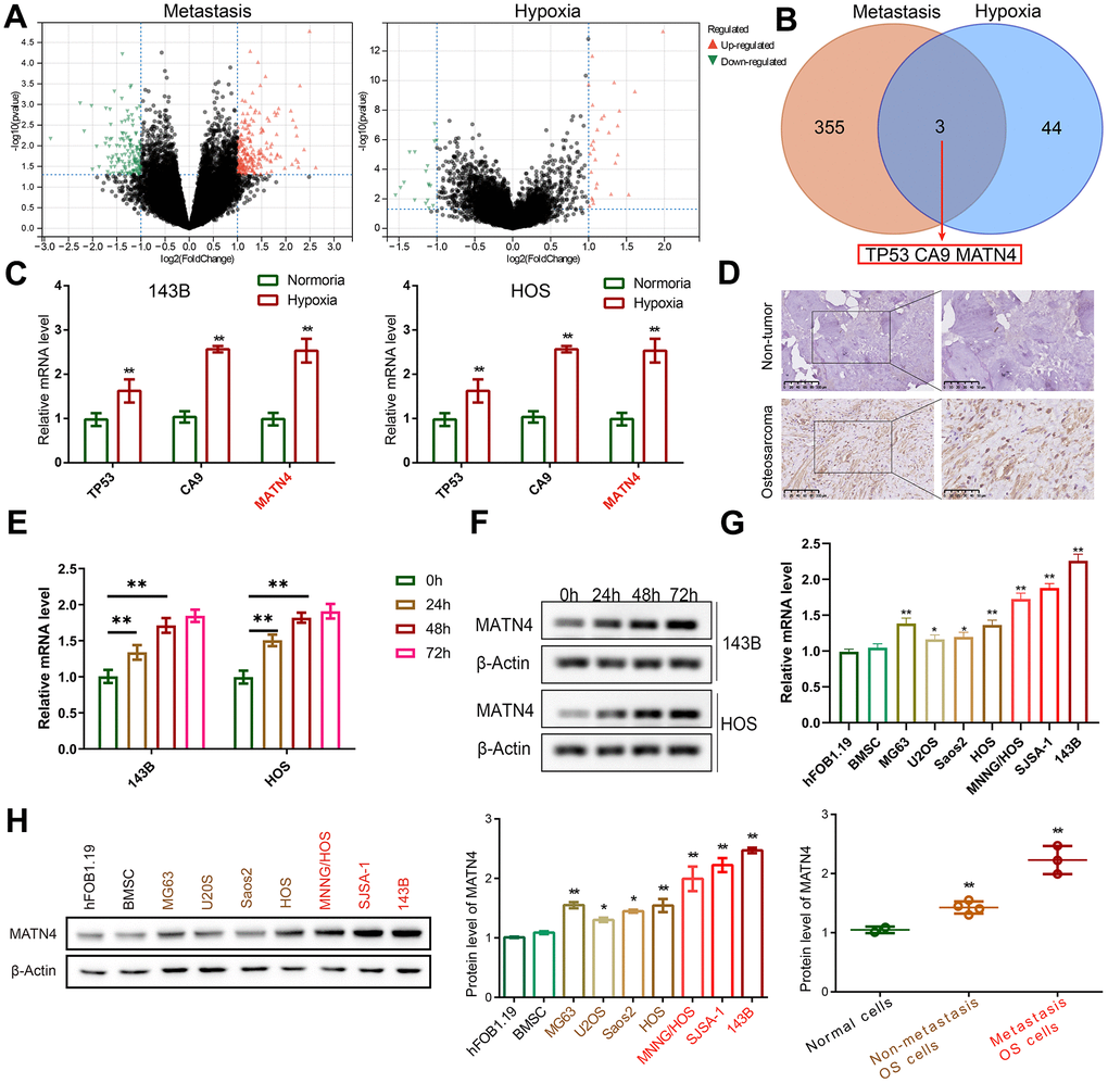MATN4 was involved in OS cell metastasis. (A) Volcano plots were used to exhibit the differentially expressed genes (DEGs) related to metastasis and hypoxia, based on gene expression profiles obtained from the Target database. (B) An intersection of DEGs: TP53, CA9, and MATN4. (C) Expression levels of TP53, CA9 and MATN4 in 143B and HOS cells were measured by RT-qPCR under normoxia or hypoxia. (D) IHC was used to exhibit protein expression level of MATN4 in OS tissue and non-cancerous bone tissue. (E, F) Western blotting and RT-qPCR to measure MATN4 mRNA and protein expression under varying hypoxic conditions. (G, H) Western blotting and RT-qPCR to measure the MATN4 protein levels in normal cells (hFOB1.19 and BMSC), in OS cells with low-metastatic ability (MG63, U2OS, Saos2, HOS), and OS cells with strong metastatic ability (MNNG/HOS, SJSA-1, 143B). *, p 