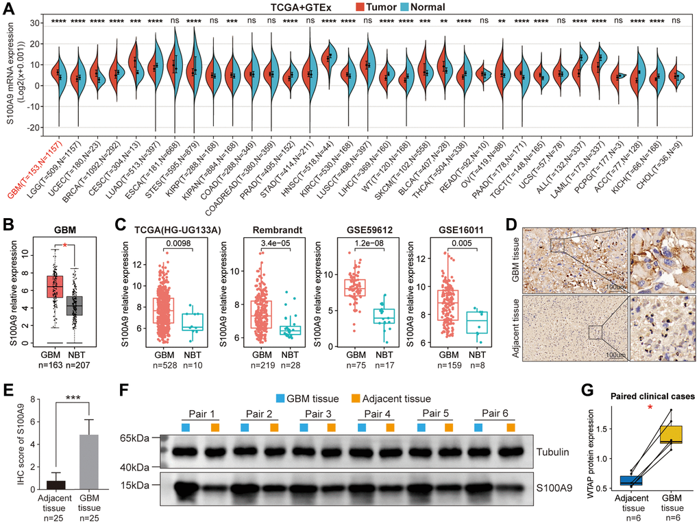 Differential expression analysis of S100A9. (A) Differential expression of S100A9 between tumor tissues and normal tissues in pan-cancer. (B) Differential expression of S100A9 between GBM tissues and NBTs in the TCGA database. (C) Differential expression analysis of S100A9 in four independent GBM cohorts. (D, E) Immunohistochemical staining of 25 pairs of GBM tissues and corresponding adjacent tissues. (F, G) Western blotting detection of six pairs of GBM tissues and corresponding adjacent tissues.