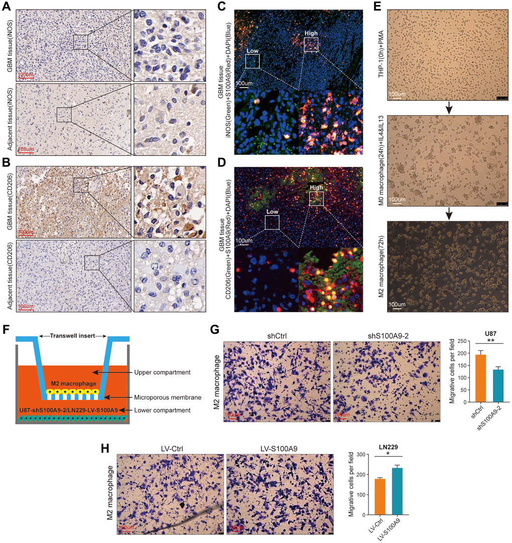 S100A9 is up-regulated in GBM tissues and contributes to the migration of M2 macrophages. (A, B) Immunohistochemical staining of iNOS (A) and CD206 (B) in GBM and its adjacent tissues. (C) Representative image of multiplex immunofluorescence staining of DAPI, iNOS, and S100A9 in GBM tissue. (D) Representative image of multiplex immunofluorescence staining of DAPI, CD206, and S100A9 in GBM tissue. (E) The process of inducing THP-1 cells into M2 macrophages. (F) Sketch map of co-culture of M2 macrophages and U87 cells transfected with knockout S100A9 lentivirus. (G, H) Transwell assay was utilized to detect the migration ability of M2 macrophages after co-culture with U87 cells transfected with lentivirus knockout S100A9 and LN229 cells transfected with lentivirus overexpressing S100A9.