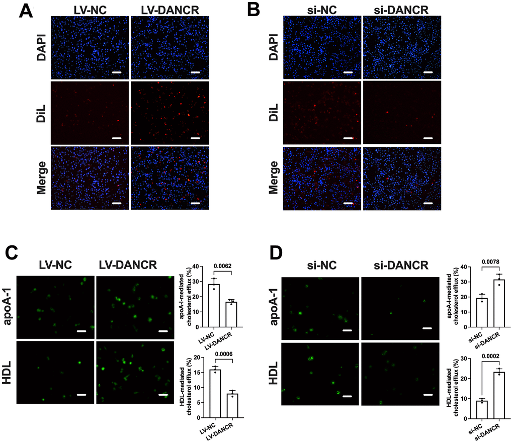 DANCR promotes lipid uptake and inhibits cholesterol efflux in THP-1 macrophages. THP-1 macrophages were treated with 50 μg/mL ox-LDL for 24 h. Then, they were transfected with 1×1010 TU/mL LV-DANCR or 20 μM si-DANCR or their corresponding control for 48 h. (A, B) Cells were incubated with 10 μg/μL Dil-ox-LDL at 37° C for 4 h. The representative fluorescent images of Dil-ox-LDL uptake were photographed (200×). (C, D) Cells were loaded with 5 μM NBD-cholesterol for 6 h. Then, the medium was supplemented with 25 μg/mL apoA-I or 50 μg/mL HDL for 4 h. The representative fluorescent images of the NBD cholesterol burden in THP-1 macrophage-derived foam cells were photographed (200×). All results are presented as the mean ± SD from three independent experiments performed in triplicate. Scale bar=50 μm.