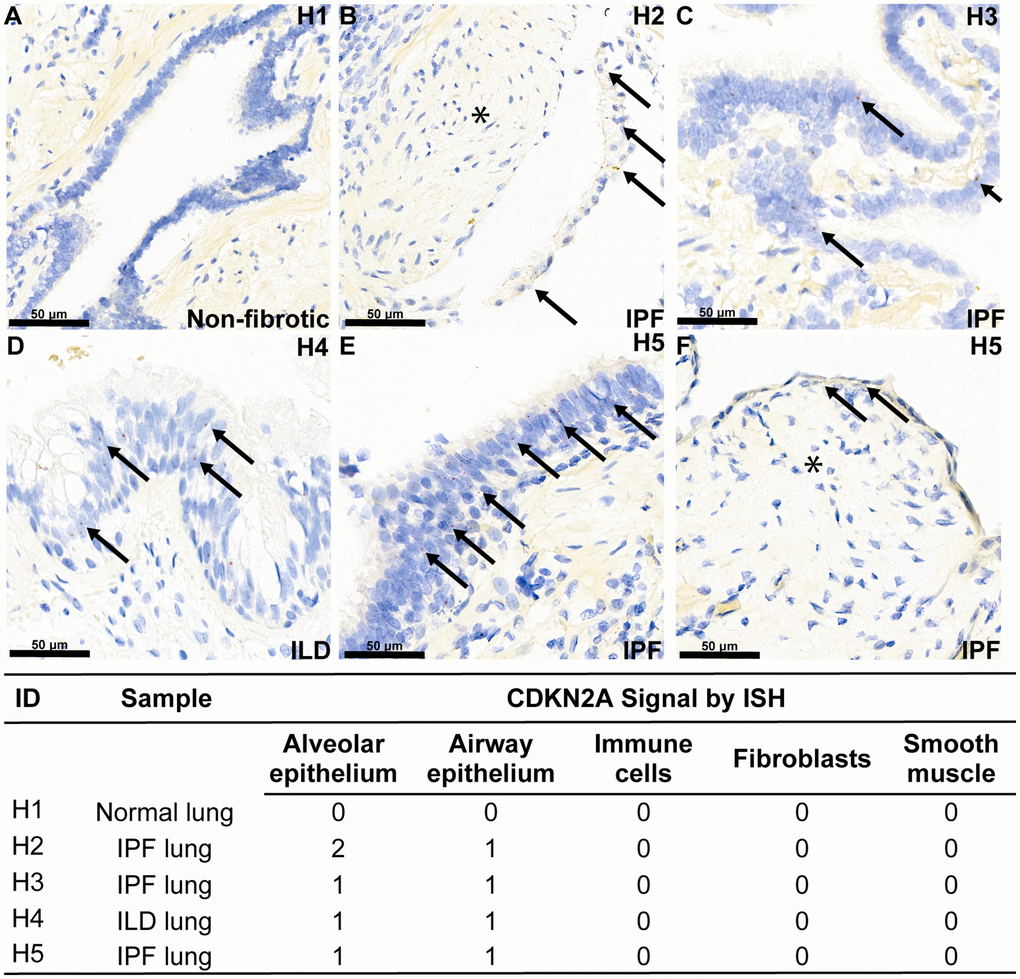 Aberrant epithelial cell senescence is a hallmark of fibrotic lung disease. RNA ISH was performed with a probe against transcript variant 1 of the human Cdkn2a gene locus, specifically detecting the p16ink4a-coding transcript, on histological slides from four human donors with end-stage interstitial lung disease or idiopathic pulmonary fibrosis and one human donor without lung disease. Demographic information is noted in Supplementary Table 1. Example red ISH puncta representing p16ink4a transcripts are identified with an arrow, and areas of p16ink4a-negative fibroblastic foci are marked with an asterisk. Expression of p16ink4a mRNA expression across cell types per donor using a semi-quantitative 0–3 scale is shown in the associated table. (A) No Cdkn2a mRNA is observed in bronchiolar epithelium of normal lung, (B–F) Cdkn2a mRNA is present in the aberrant epithelium overlying fibroblastic foci (asterisk) and in the aberrant epithelium lining honeycomb cysts in diseased lung.