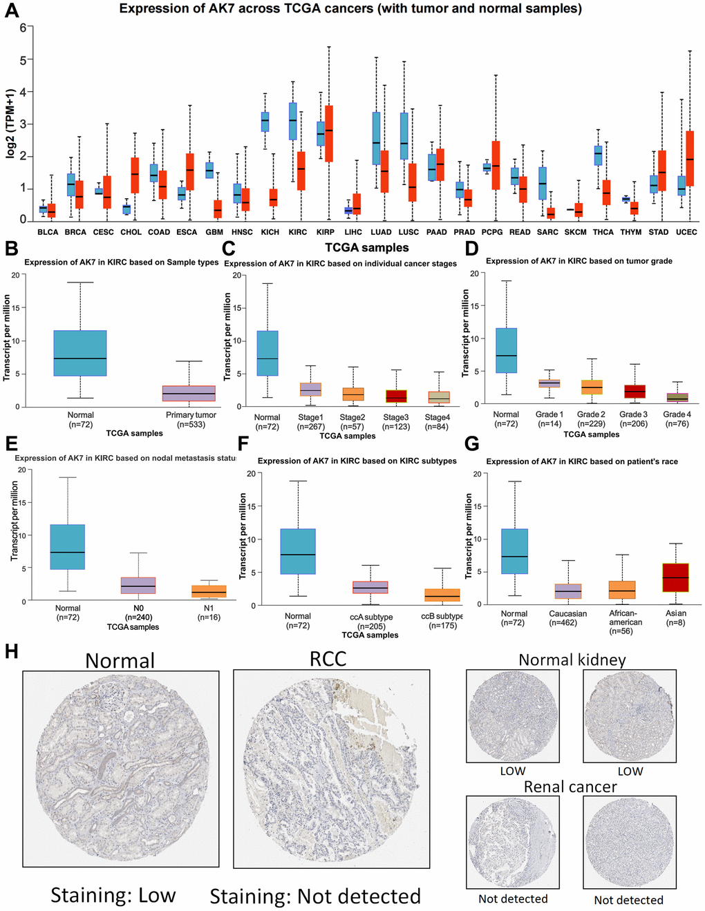 Expression profile of AK7 in tumor. (A) Expression of AK7 mRNA in different cancers and corresponding normal tissues. (B) The expression of AK7 mRNA in ccRCC was significantly higher than that in normal kidney tissue. (C–G) Differences in SPC25 mRNA expression depending on stage, grade, nodal metastasis status, subtype and race. (H) Expression of AK7 in normal renal tissues and ccRCC tissues. *P **P ***P ****P 