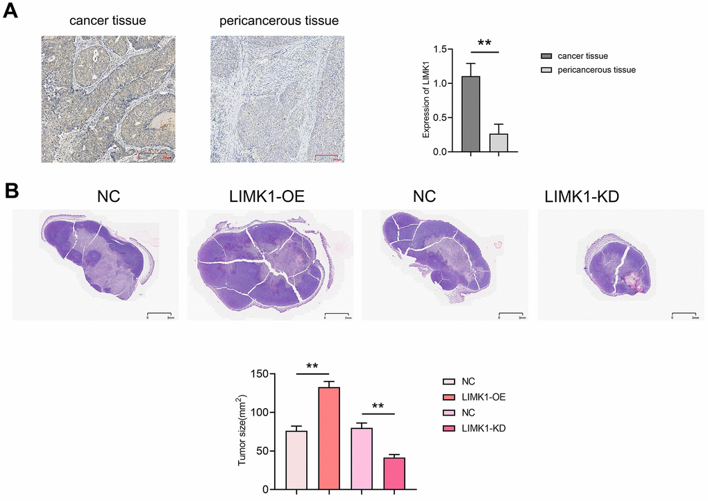 LIMK1 promoted the growth of cervical cancer. (A) Diagram of LIMK1 immunohistochemical staining results of cancer tissues and paracancerous tissues of cervical cancer patients and statistical results of LIMK1 expression; (B) representative micrographs of HE staining results of tumors in each group of mice and statistical histograms of tumor section areas. **P