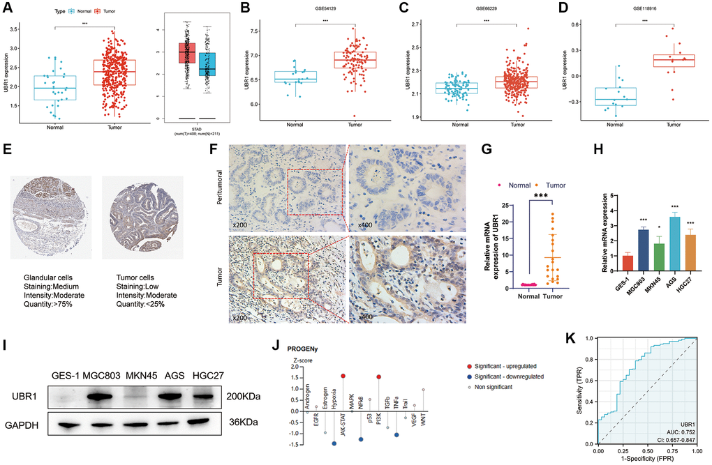 Elevated expression and diagnostic potential of UBR1 in gastric cancer. (A) UBR1 expression levels were analyzed using the TCGA and GTEx databases to provide a comprehensive overview of its expression in gastric cancer (GC). (B–D) To further validate and compare findings, UBR1 expression was examined across three GEO datasets: GSE54129, GSE66229, and GSE118916. (E) Immunohistochemical tissue microarray images from the HPA database highlighted UBR1 protein expression in various tissues. (F) Immunohistochemical protein expression levels of UBR1 in gastric cancer tissues and adjacent non-cancerous tissues. (G) Analysis of UBR1 mRNA levels in 21 pairs of GC and adjacent tissue samples showed significant differences, emphasizing its elevated expression in cancer tissues (****p ***p **p *p H) qPCR verification confirmed the elevated levels of UBR1 mRNA in four GC cell lines (MGC803, MKN45, AGS, and HGC27) compared to normal gastric mucosal cells (GES-1) (****p ***p **p *p I) Western blot analysis validated the protein expression of UBR1 in GES-1, MGC803, MKN45, AGS, and HGC27 cells, corroborating the mRNA findings. (J) Using data from the HPA database, predicted pathways and functions of UBR1 were identified, showing enrichment in AGS cells. (K) ROC curve analysis, based on TCGA data, evaluated the diagnostic potential of UBR1 in GC patients.