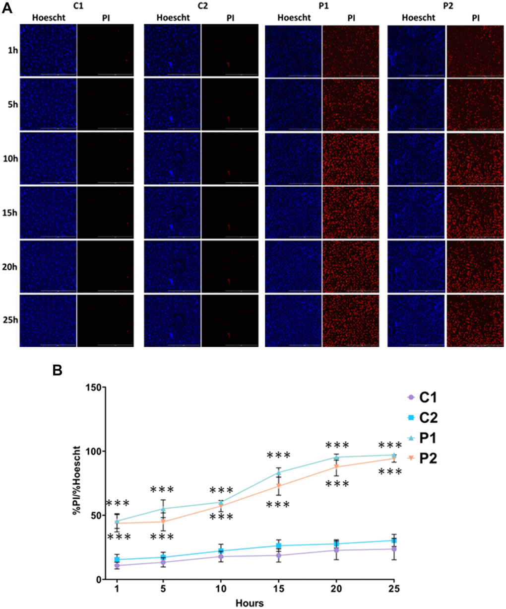 Sensitivity to ferroptosis in control (C1, C2) and MS (P1, P2) cells. Cells were treated with 5 μM erastin and stained with Hoechst (blue fluorescence) and propidium iodide (PI, red fluorescence) to distinguish between dead and live cells. (A) Representative images of live and dead cells upon addition of erastin for 25 hours. Scale bar = 20 μm. (B) Quantification of cell death over time. Data represent the mean ± SD of three independent experiments. ***p-value  between control and MS fibroblasts.
