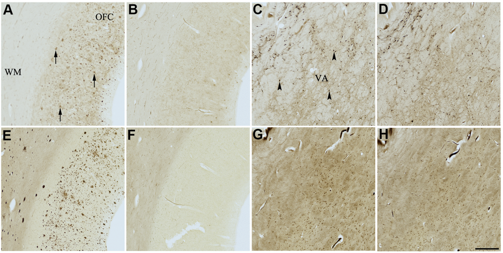 Effect of dasatinib (1) on histochemical staining of acetylcholinesterase (AChE) and butyrylcholinesterase (BChE). Representative photomicrographs of histochemical staining of AChE (A–D) and BChE (E–H). Staining at pH 6.8 demonstrates AChE- (A) and BChE (E)-associated plaques in the Alzheimer’s disease (AD) orbitofrontal cortex (arrows). Staining at pH 8.0 demonstrates AChE (C) and BChE (G) associated with normal neural structures in the AD thalamus (arrowheads showing neurons). Dasatinib (1) inhibits AChE (B) and BChE (F) associated with AD plaques but not AChE (D) and BChE (H) associated with normal neural elements. Note, for ease of reference, identical images of the positive control staining of AChE and BChE at pH 6.8 and 8.0 (A, C, E, G) were used herein and in Figures 5-9 (A, C, E, G) to help compare directly the effects of each senolytic or nootropic agent on the standard Karnovsky-Roots (KR) histochemical staining method. Abbreviations: OFC, orbitofrontal cortex; VA, ventroanterior thalamic nucleus; WM, white matter. Scale bar = 500 μm.