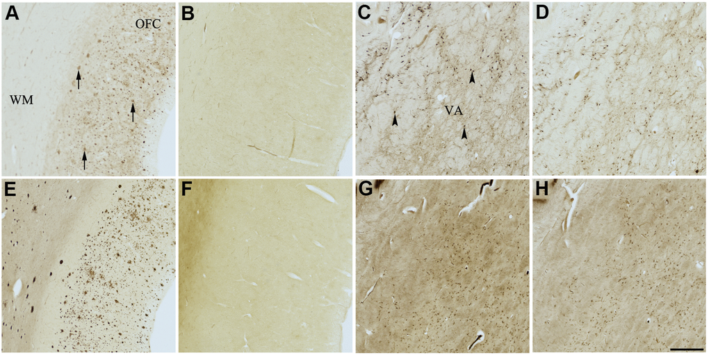 Effect of nintedanib (2) on histochemical staining of acetylcholinesterase (AChE) and butyrylcholinesterase (BChE). Representative photomicrographs of histochemical staining of AChE (A–D) and BChE (E–H). Staining at pH 6.8 demonstrates AChE- (A) and BChE (E)-associated plaques in the Alzheimer’s disease (AD) orbitofrontal cortex (arrows). Staining at pH 8.0 demonstrates AChE (C) and BChE (G) associated with normal neural structures in the AD thalamus (arrowheads showing neurons). Nintedanib (2) inhibits AChE (B) and BChE (F) associated with AD plaques but not AChE (D) and BChE (H) associated with normal neural elements. Note, for ease of reference, identical images of the positive control staining of AChE and BChE at pH 6.8 and 8.0 (A, C, E, G) were used herein and in Figures 4, 6–9 (A, C, E, G) to help compare directly the effects of each senolytic or nootropic agent on the standard Karnovsky-Roots (KR) histochemical staining method. Abbreviations: OFC, orbitofrontal cortex; VA, ventroanterior thalamic nucleus; WM, white matter. Scale bar = 500 μm.