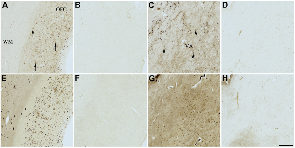 Effect of fisetin (3) on histochemical staining of acetylcholinesterase (AChE) and butyrylcholinesterase (BChE). Representative photomicrographs of histochemical staining of AChE (A–D) and BChE (E–H). Staining at pH 6.8 demonstrates AChE- (A) and BChE (E)-associated plaques in the Alzheimer’s disease (AD) orbitofrontal cortex (arrows). Staining at pH 8.0 demonstrates AChE (C) and BChE (G) associated with normal neural structures in the AD thalamus (arrowheads showing neurons). Staining reactions for AChE and BChE at pH 6.8 (B and F) or pH 8.0 (D and H) in the presence of fisetin (3) could not be done due to compound 3 precipitating out of solution, most likely due to chelating with metal ions required for the Karnovsky-Roots (KR) staining method. Note, for ease of reference, identical images of the positive control staining of AChE and BChE at pH 6.8 and 8.0 (A, C, E, G) were used herein and in Figures 4, 5, 7–9 (A, C, E, G) to help compare directly the effects of each senolytic or nootropic agent on the standard KR histochemical staining method. Abbreviations: OFC, orbitofrontal cortex; VA, ventroanterior thalamic nucleus; WM, white matter. Scale bar = 500 μm.