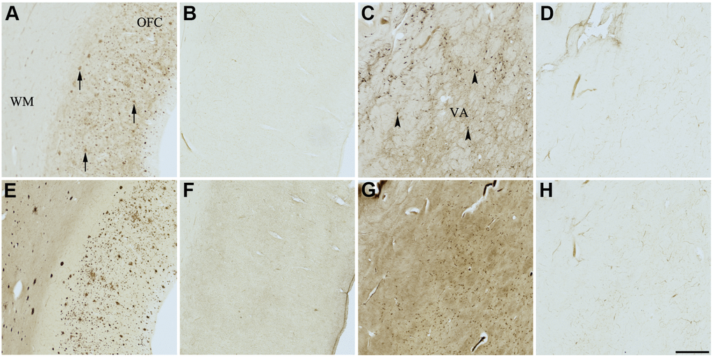 Effect of quercetin (4) on histochemical staining of acetylcholinesterase (AChE) and butyrylcholinesterase (BChE). Representative photomicrographs of histochemical staining of AChE (A–D) and BChE (E–H). Staining at pH 6.8 demonstrates AChE- (A) and BChE (E)-associated plaques in the Alzheimer’s disease (AD) orbitofrontal cortex (arrows). Staining at pH 8.0 demonstrates AChE (C) and BChE (G) associated with normal neural structures in the AD thalamus (arrowheads showing neurons). Staining reactions for AChE and BChE at pH 6.8 (B and F) or pH 8.0 (D and H) in the presence of quercetin (4) could not be done due to compound 4 precipitating out of solution, most likely due to chelating with metal ions required for the Karnovsky-Roots (KR) staining method. Note, for ease of reference, identical images of the positive control staining of AChE and BChE at pH 6.8 and 8.0 (A, C, E, G) were used herein and in Figures 4–6, 8, 9 (A, C, E, G) to help compare directly the effects of each senolytic or nootropic agent on the standard BChE KR histochemical staining method. Abbreviations: OFC, orbitofrontal cortex; VA, ventroanterior thalamic nucleus; WM, white matter. Scale bar = 500 μm.