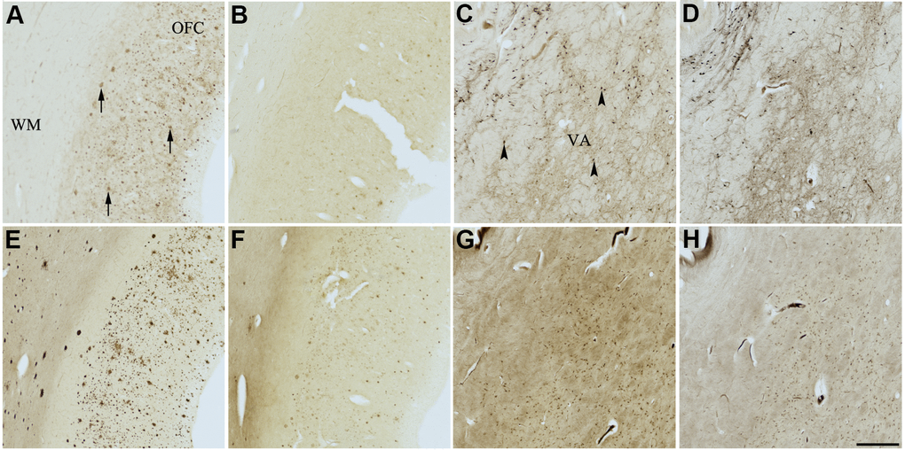 Effect of meclofenoxate hydrochloride (6) on histochemical staining of acetylcholinesterase (AChE) and butyrylcholinesterase (BChE). Representative photomicrographs of histochemical staining of AChE (A–D) and BChE (E–H). Staining at pH 6.8 demonstrates AChE- (A) and BChE (E)-associated plaques in the Alzheimer’s disease (AD) orbitofrontal cortex (arrows). Staining at pH 8.0 demonstrates AChE (C) and BChE (G) associated with normal neural structures in the AD thalamus (arrowheads showing neurons). Meclofenoxate hydrochloride (6) inhibits AChE (B) and, to a certain extent, BChE (F) associated with AD plaques but not AChE (D) and BChE (H) associated with normal neural elements. Note, for ease of reference, identical images of the positive control staining of AChE and BChE at pH 6.8 and 8.0 (A, C, E, G) were used herein and in Figures 4-8 (A, C, E, G) to help compare directly the effects of each senolytic or nootropic agent on the standard Karnovsky-Roots (KR) histochemical staining method. Abbreviations: OFC, orbitofrontal cortex; VA, ventroanterior thalamic nucleus; WM, white matter. Scale bar = 500 μm.