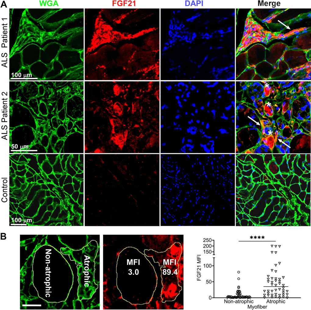 FGF21 localizes to atrophic myofibers in ALS muscle. (A) Tissue sections from two ALS patients and one normal control were immunostained with an anti-FGF21 antibody and counterstained with DAPI and wheat germ agglutin (WGA). Intense immunoreactivity is observed in atrophic myofibers (asterisks) and in the endomysial space (arrows) in the ALS muscle sections. Scale bars, 100 μm in low power views and 50 μm in the enlarged views. (B) Mean fluorescence Intensity (MFI) analysis of FGF21 immunoreactivity was performed in 5 ALS patient biopsy samples and 5 normal controls. Atrophic (2) was quantitated for 46 atrophic and non-atrophic myofibers and summarized in the graph (horizontal line represents the mean). ****P  0.0001; two-tailed Mann Whitney test. Scale bar: 50 μm.