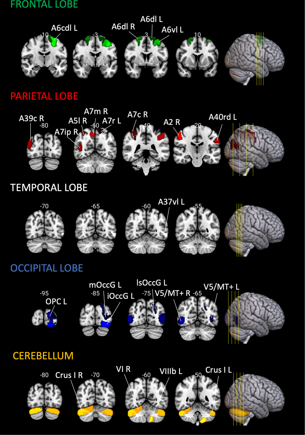 Location of the brain regions analyzed. Brain regions analyzed, visualized in the coronal plane, in the MNI152 Template. Cortical regions were labeled using the Brainnetome Atlas [38], and cerebellar regions with Cerebellum SUIT Atlas [39]. Brain slices and volumes depicted in this figure were created with MRIcroGL (Version 1.2.20220720b; https://www.nitrc.org/projects/mricrogl) [37].
