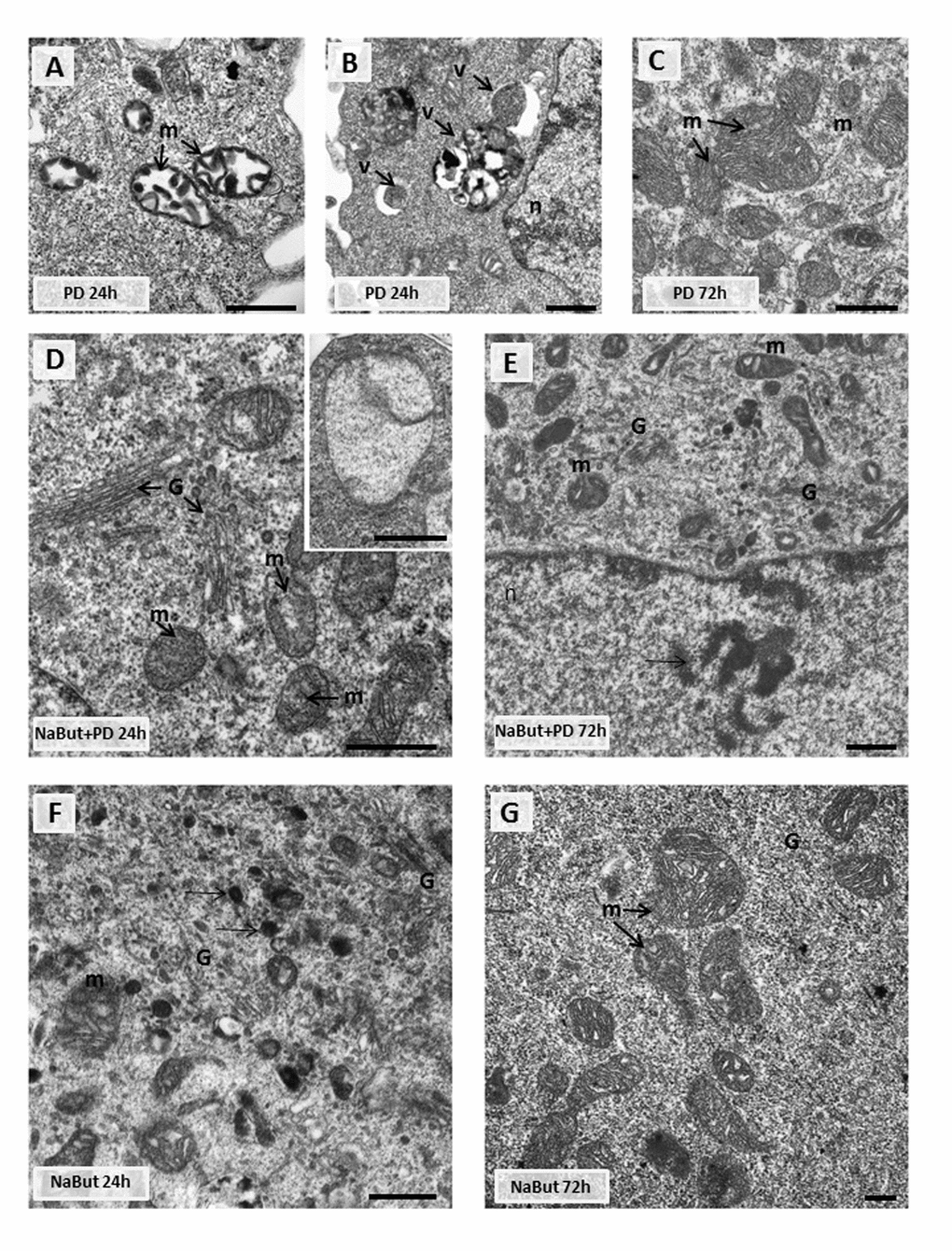 Transmission electron microscopy (TEM) images showing the ultrastructure of intact and senescent ERas cells treated with inhibitor of MEK/ERK-pathway (A,B,C). Representative images of the mitochondria in intact ERas cells after MEK/ERK suppression. Note severe alterations of mitochondria (m) after 24 hours of treatment (A), mitochondria in autophagosome-like vesicles (B) and normal-looking mitochondria after 72 hours of treatment (C). (D) Representative image of senescent ERas cell treated with PD for 24 hours. It contains well-developed Golgi apparatus (G) and mitochondria (m) with rare cristae. Inset: mitochondria with complete loss of the cristae and the preserved double-membrane envelope. (E) Representative image of senescent ERas cell treated with PD for 72 hours. The cell contains well-developed Golgi apparatus and swollen mitochondria with vacuolar structure. Note poorly developed nucleoli (arrow). The senescent ERas cells after 24 (F) and 72 (G) hours of NaBut exposure. Stacks of Golgi cisternae and lysosome-like structures (F, arrows) can be seen. Designations: G, Golgi; m, mitochondria; n, nucleus; v, vesicle. Scale bars: 500 nm.