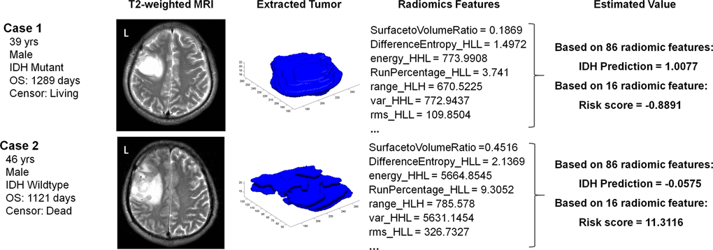 Case examples of LGG patients with T2-weighted images. Case 1 was a 39-year-old male with an IDH mutant LGG. This patient was classified into the IDHMUT group with a relatively low risk score based on the radiomic features. In contrast, case 2 was a 46-year-old male with an IDH wildtype LGG, who was correctly classified into the IDHWT group with a high risk score.