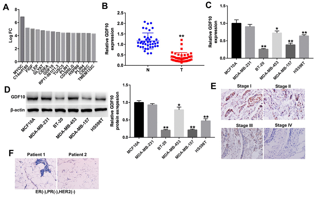 GDF10 expression in human TNBC specimens and cell lines. (A) Differentially expressed mRNAs (log2 fold-change (FC) ≥ 4) in TNBC samples. (B) Relative expression of GDF10 in tumors and adjacent normal tissues (N) from TNBC patients (n = 40). **P C) The levels of GDF10 in TNBC cell lines (MDA-MB-231, BT-20, MDA-MB-453, MDA-MB-157 and HS598T), and in normal mammary epithelial cells (MCF10A) were detected by qRT-PCR. *P D) GDF10 expression in MCF10A, MDA-MB-231, BT-20, MDA-MB-453, MDA-MB-157 and HS598T cells assessed by western blotting. β-actin was used as internal control. *P E) Representative GDF10 IHC staining (×200) of stages I, II, III, and IV TNBC samples. (F) IHC staining images of ER-negative nuclear expression, PR negative nuclear expression and HER-2/neu negative expression (magnification x 200) in patients with TNBC.