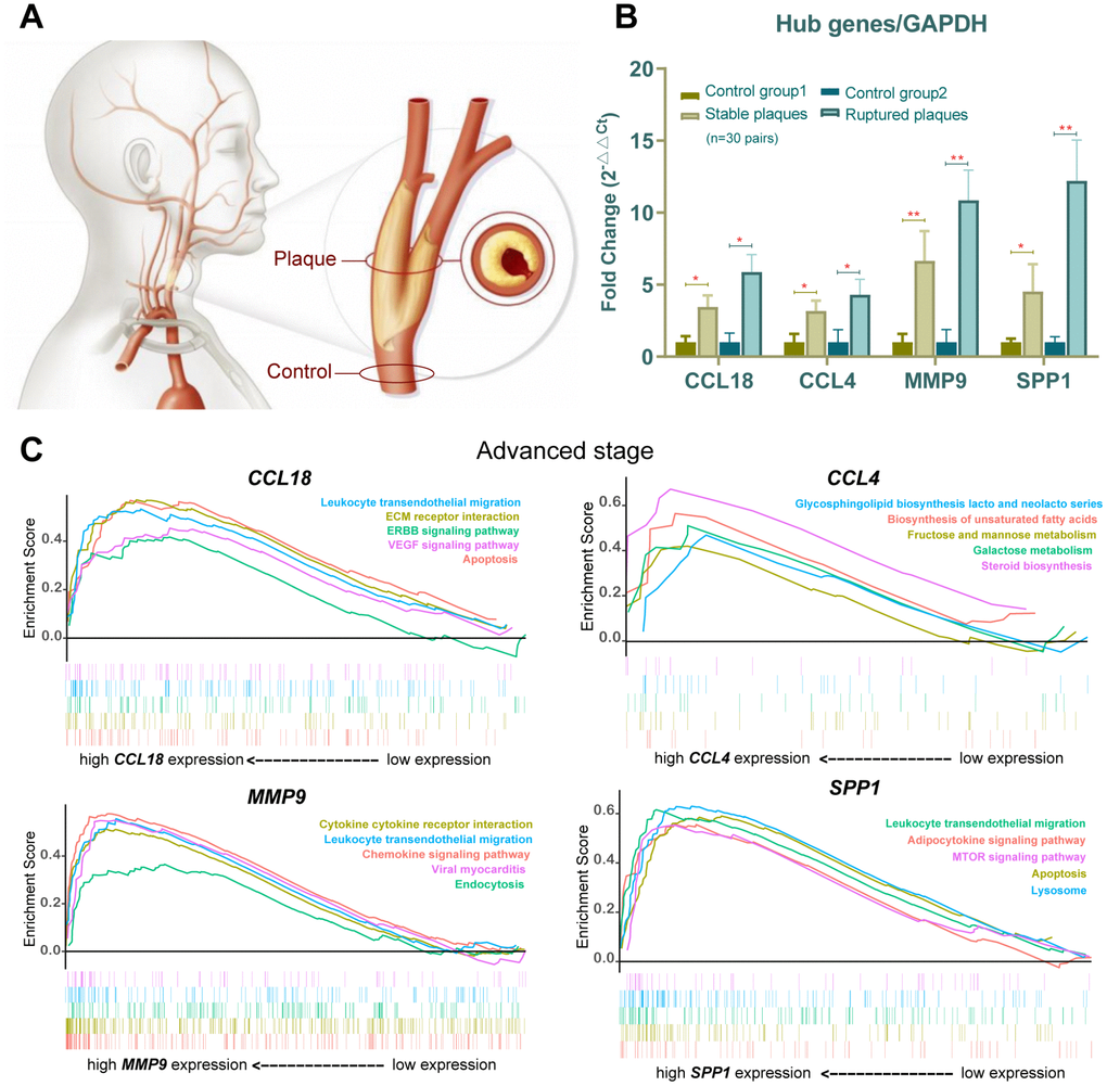 Verification in the clinical samples and gene set enrichment analysis (GSEA). (A) Human carotid artery segments were collected from below (normal control) and at (plaque-containing) the carotid bifurcation. (B) CCL18, CCL4, MMP9 and SPP1 expression in stable plaques (n=15 pair) and ruptured plaques (n=15 pair) were evaluated by qPCR and normalized against the corresponding glyceraldehyde-3-phosphate dehydrogenase (GAPDH) expression. An asterisk represents ppC) Gene set enrichment analysis (GSEA) plots showing lipid metabolism and inflammatory immune-related gene sets progressively affected advanced-stage AS.