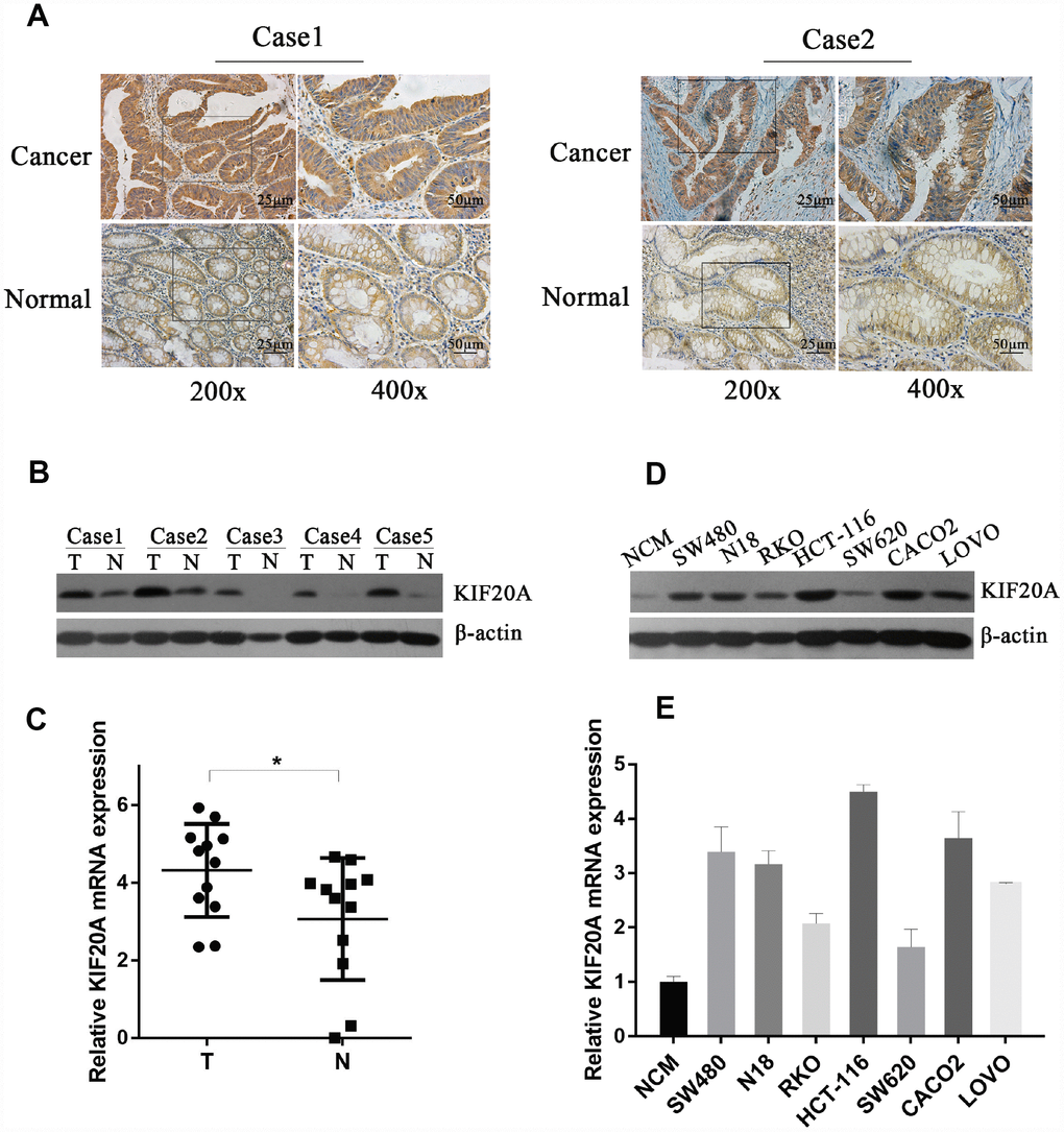 KIF20A is significantly upregulated in CRC. (A) Immunohistochemical analysis of KIF20A in paraffin tissues from CRC tissues and normal colorectal tissues of two patients (case 1 and case 2). (B) Western blot analysis of KIF20A in five pairs of CRC and paracancerous tissues. (C) mRNA level of KIF20A in twelve pairs of CRC and paracancerous tissues were detected by RT-PCR. Data are presented as mean ± SEM. *P D–E) Western blot and RT-PCR analysis of KIF20A in a normal colorectal cell line (NCM) and seven CRC cell lines. Data are presented as mean ± SEM.