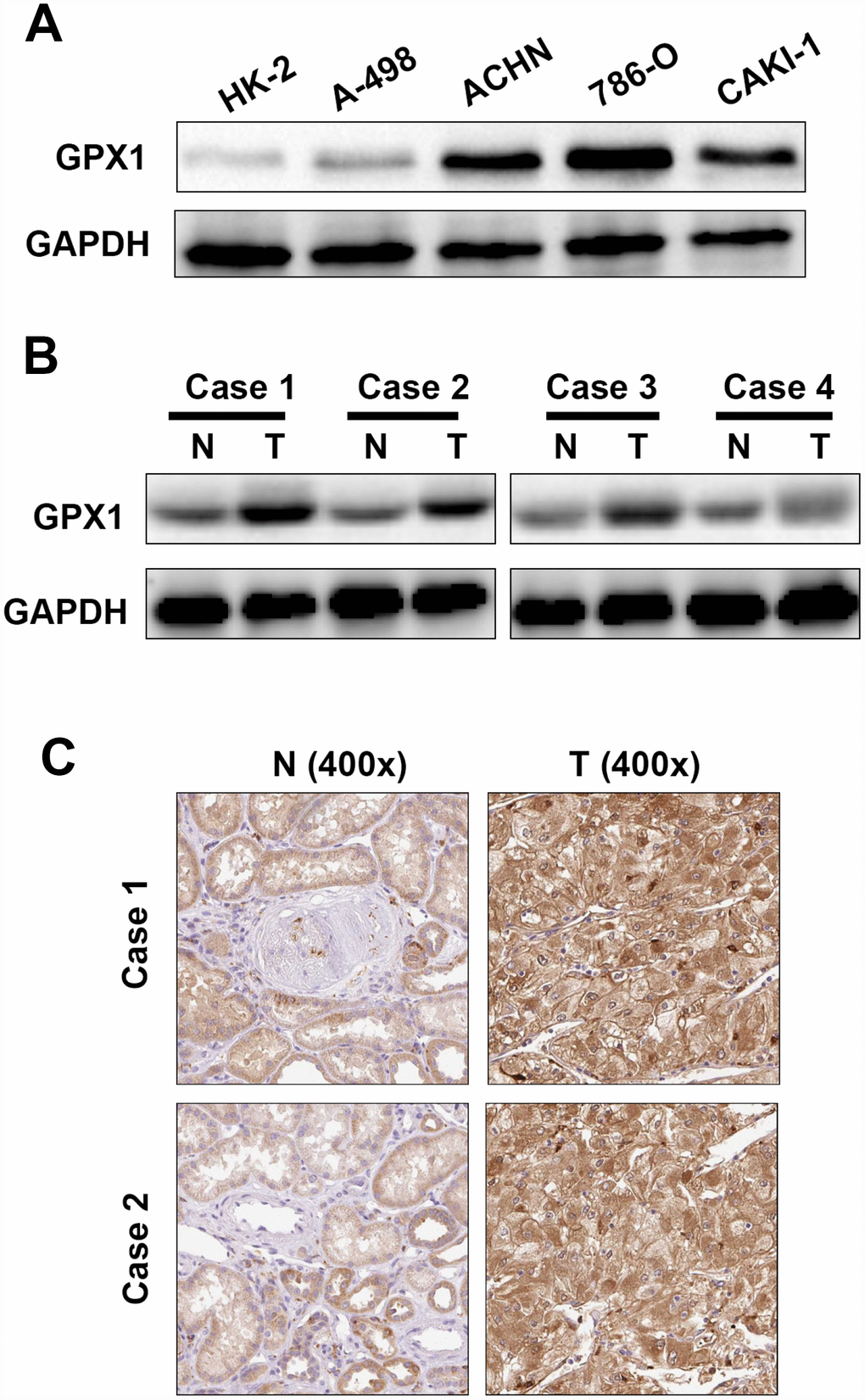 The expression levels of GPX1 in renal cancer cells and tissues. (A) Western blotting analysis of GPX1 expression levels in renal cancer cell lines (786-O, ACHN, A-498, Caki-1) and renal normal epithelial cells (HK-2). (B) Western blotting analysis of GPX1 expression levels in 4 pairs of ccRCC tissues (T = tumor tissue, N = normal tissue). (C) Immunohistochemical analysis of GPX1 expression levels in normal renal tissues and ccRCC tissues (T = tumor tissue, N = normal tissue).