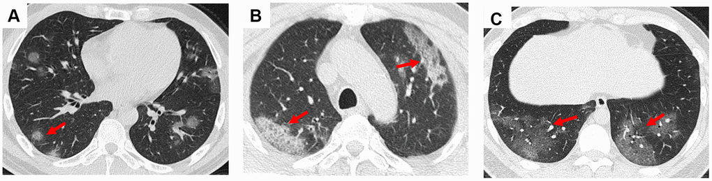 Ground-glass opacity and crazy paving in the CT scans of COVID-19 pneumonia patients. (A) Multiple nodular ground-glass opacity scattered in both lungs of a 44-year-old male patient; (B) Mixed ground-glass opacity along the long axis of subpleural in both lungs of a 67-year-old male patient; (C) Crazy paving was observed in the bilateral lower lungs of a 67-year-old male patient at the fourth day since admission. Typical lesions were marked with red arrows.