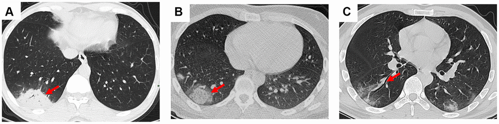 Consolidation, halo sign, and bronchiectasia in the CT scans of COVID-19 pneumonia patients. (A) Consolidation accompanying air bronchogram sign was found in the right lower lobe of a 46-year-old male patient; (B) Halo sign was observed in the right lower lobe of a 18-year-old male patient; (C) Bronchiectasia was observed in the right lower lobe of a 30-year-old male patient with bilateral ground-glass opacity. Typical lesions were marked with red arrows.