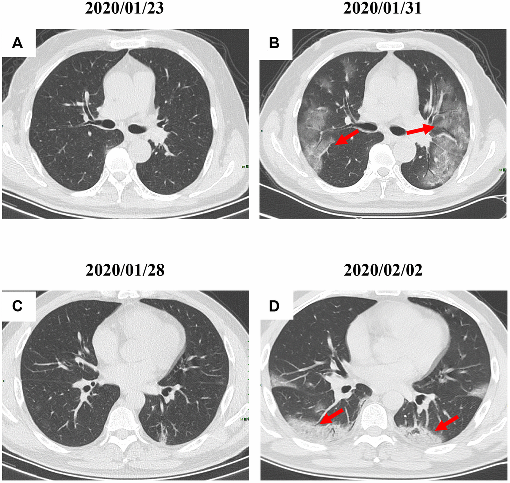 Radiological worsen progression of two COVID-19 pneumonia patients. (A, B): Bilateral, large, and multiple ground-glass opacity was observed in a 47-year-old male patient with type 2 diabetes after 8 days since admission; (C, D) Consolidation accompanying air bronchogram were found in the bilateral lower lungs of a 29-year-old male patient after 5 days since admission. Typical lesions were marked with red arrows.