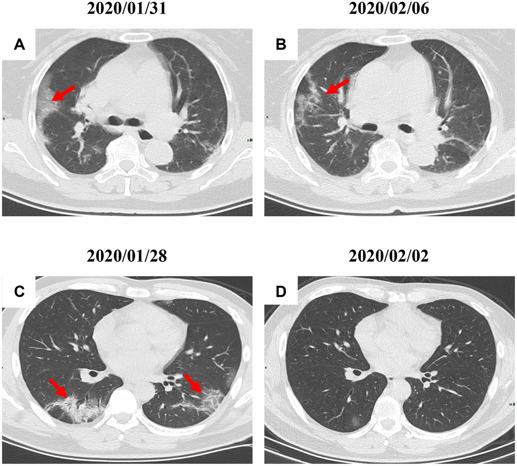 Radiological improvement of two COVID-19 pneumonia patients. (A, B) Patch lesions were absorbed and changed into reticular spline ones (a 31-year-old female patient); (C–D) Significant improvement of CT sign was achieved in a 22-year-old male patient. Typical lesions were marked with red arrows.