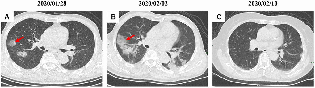 A serial CT images after admission of a 54-year-old male patient. (A) Patch ground-glass opacity was observed in the middle right lobe. (B) 5 days later, significant larger patch ground-glass opacities were observed in bilateral lungs. (C) Follow-up CT scans on day 13 after admission show a remarkable improvement. Typical lesions were marked with red arrows.