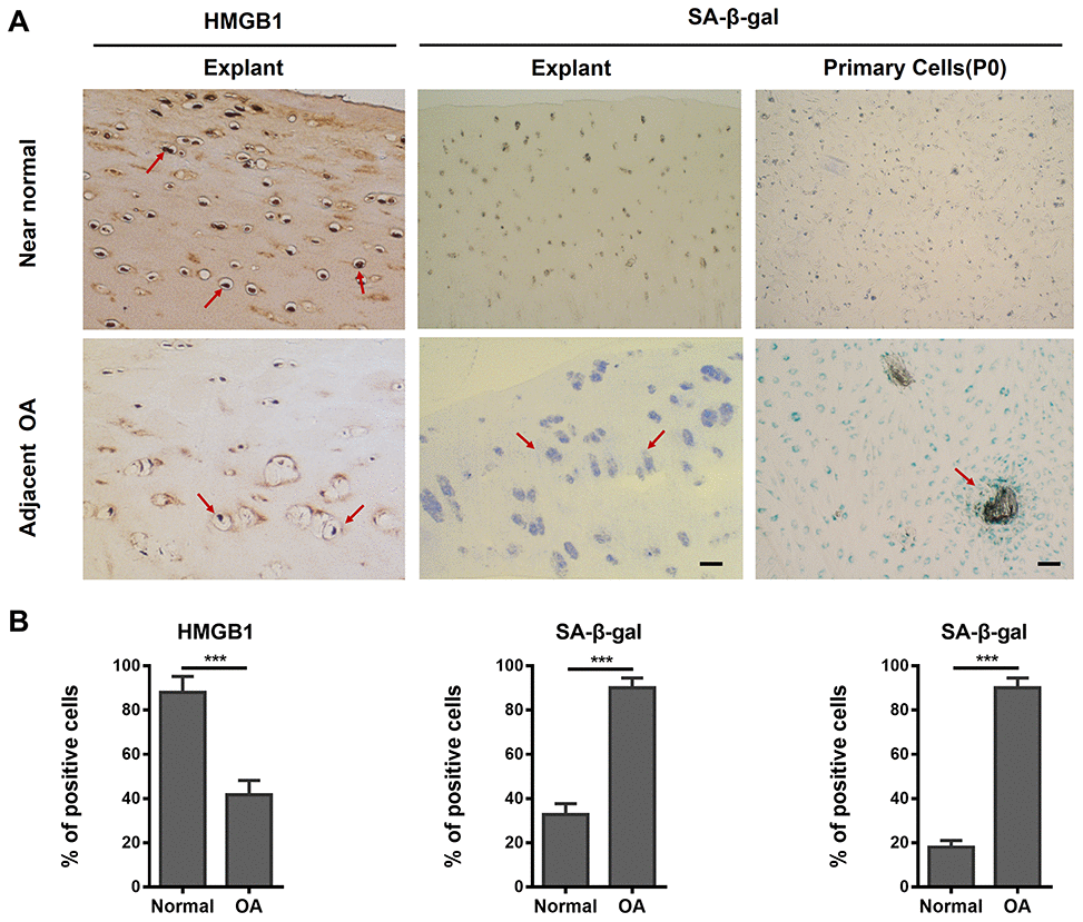 The presence of senescent human chondrocytes (SnCs) in adjacent normal and advanced osteoarthritic articular cartilage. (A) Representative images of HMGB1-positive non-SnCs (brown staining at red arrows, scale bars, 100 μm) by immunohistochemistry and SA-β-gal-positive SnCs expression on OA articular cartilage, OA chondrocytes (P0) and adjacent normal cartilage. (B) The statistical analysis of the percentage of SA-β-gal and HMGB1 positive cells from three independent experiments. Scale bar: 100 μm.