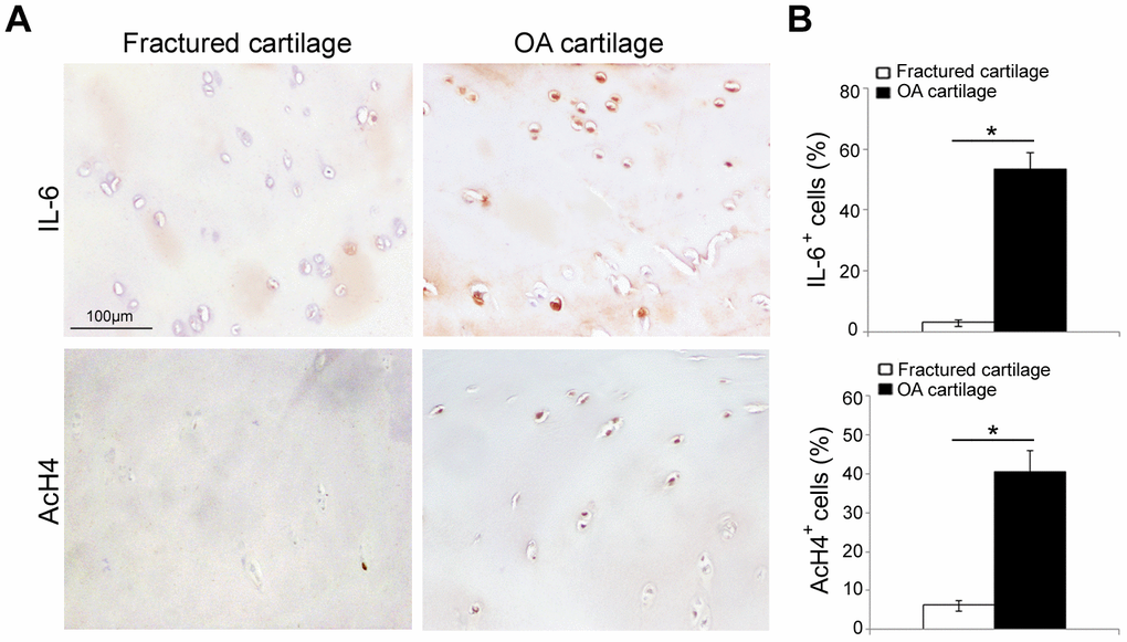 IL-6 and AcH4 expression in articular cartilage of fractured and OA patients. (A) Representative immunohistochemical images of IL-6 and AcH4 expression in femoral cartilage of fractured (n=30) and OA patients (n=30). (B) Bar graphs show semi-quantitative evaluation of IL-6 and AcH4. Results are expressed as mean values ± SEM. Student’s t-test: *P 