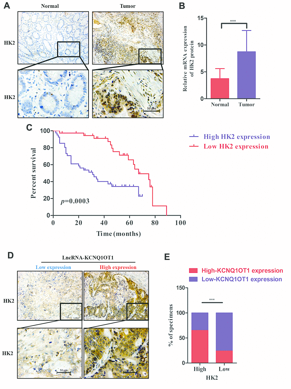 HK2 protein levels correlate with prognosis and KCNQ1OT1 expression in CRC patients. (A) Representative images show immunohistochemical staining of HK2 protein in 79 pairs of colorectal cancer and adjacent normal colorectal tissues using anti-HK2 antibodies. (B) QRT-PCR analysis shows HK2 mRNA levels in 79 pairs of colorectal cancer and adjacent normal colorectal tissues. (C) Kaplan–Meier survival curve analysis shows overall survival (OS) of colorectal cancer patients with low and high levels of HK2 mRNA. (D, E) Correlation analysis shows the relationship between HK2 expression (based on IHC analysis) and lncRNA KCNQ1OT1 levels (qRT-PCR) in 79 colorectal cancer patients. Note: ***p 