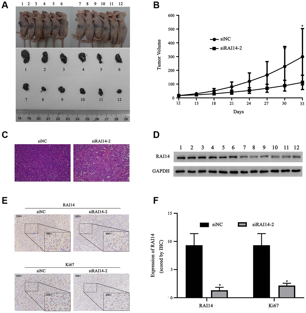 RAI14 knockdown prevents tumor growth of EC in vivo. Nude mice were injected with TE-1 cells that were transfected with siNC (Nos. 1–6) or siRAI14-2 (Nos. 7–12). (A) Tumor volume in mice. (B) Growth curve of tumor volume (mm3). (C) HE staining of tumor samples. (D) The protein expression of RAI14 was determined by Western blotting. (E) Immunohistochemical results of RAI14 and Ki67 expression in tumor tissue samples. (F) The immunohistochemical assay score in each group. *P 