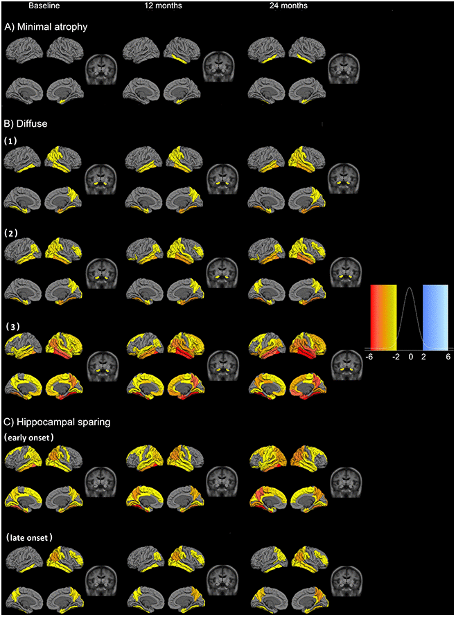 Fitted values for cortical thickness and subcortical volumes for the different patterns of atrophy. Atrophy fitted values of the six longitudinal atrophy patterns for the AD sample. Each row presents the median fitted values of the cortical and subcortical atrophy of the six components for three time points (baseline, 12 and 24 months from the first measurement). The data are presented as cognitively unimpaired group z-scores. (A) minimal atrophy pattern, (B) diffuse AD atrophy pattern, (C) hippocampal sparing AD atrophy pattern. Fixed effects: Intracranial volume = average Intracranial volume, Sex= female, Age = 75 years, Time from onset of dementia = 5 years, Education = 16 years, CSF Aβ1-42 = 100 pg/ml, CSF pTau 181P = 50 pg/ml. Data are presented as standard deviations below the estimated mean of the healthy cognitively unimpaired population.