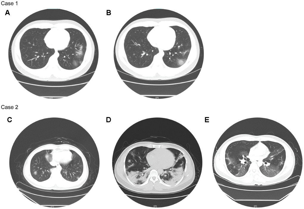 Chest CTs of two representative cases. Case 1 (non-severe): Chest CT on Feb 24 (A) showed multiple patchy ground-glass opacity in both lungs, with unclear borders and uneven density. Chest CT on Feb 28 (B) showed better status, and some lesions were slightly absorbed than before. Case 2 (severe): Chest CT on Jan 29 (C) showed the texture of both lungs was slightly increased, and both lungs were scattered in patchy shadows, whose edges were blurred. Chest CT on Feb 11 (D) showed the scope of the bilateral lung lesions was enlarged, the density was increased, and the local consolidation and bronchial signs were seen. Chest CT on Mar 4 (E) showed improved status, and both lung lesions were significantly less than before.