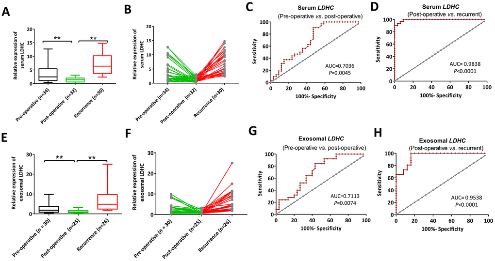 Serum (A, B) and exosomal (C, D) LDHC expressions in pre-operative, post-operative and recurrent patients with HCC. ROC curves of serum and exosomal LDHC mRNA expressions in the distinction between (E–H) pre-operative, post-operative, and recurrent cases. **Pvs. post-operative.