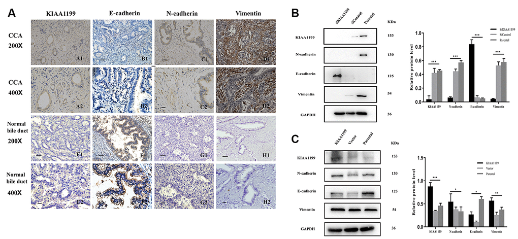 Immunohistochemical staining for KIAA1199, E-cadherin, N-cadherin and vimentin. (A). A1, A2: Positive KIAA1199 expression in CCA tissue. E1, E2: Negative KIAA1199expression in adjacent tissue. B1, B2: Negative E-cadherin expression in CCA tissue. F1, F2: Positive E-cadherin expression in adjacent tissue. C1, C2: Positive N-cadherin expression in CCA tissue. G1, G2: Positive Vimentin expression in CCA tissue. H1, H2: Negative Vimentin expression in adjacent tissue. (scale bar, 50 μm; magnification: ×200, ×400) (B) Western blot analysis of EMT signaling molecules (N-cadherin, E-cadherin and Vimentin) in KIAA1199 silenced Hucct1 cell line. (C) Western blot analysis of EMT signaling molecules ((N-cadherin, E-cadherin and Vimentin) in KIAA1199 overexpressed QBC939 cell line. Representative of three independent experiments.