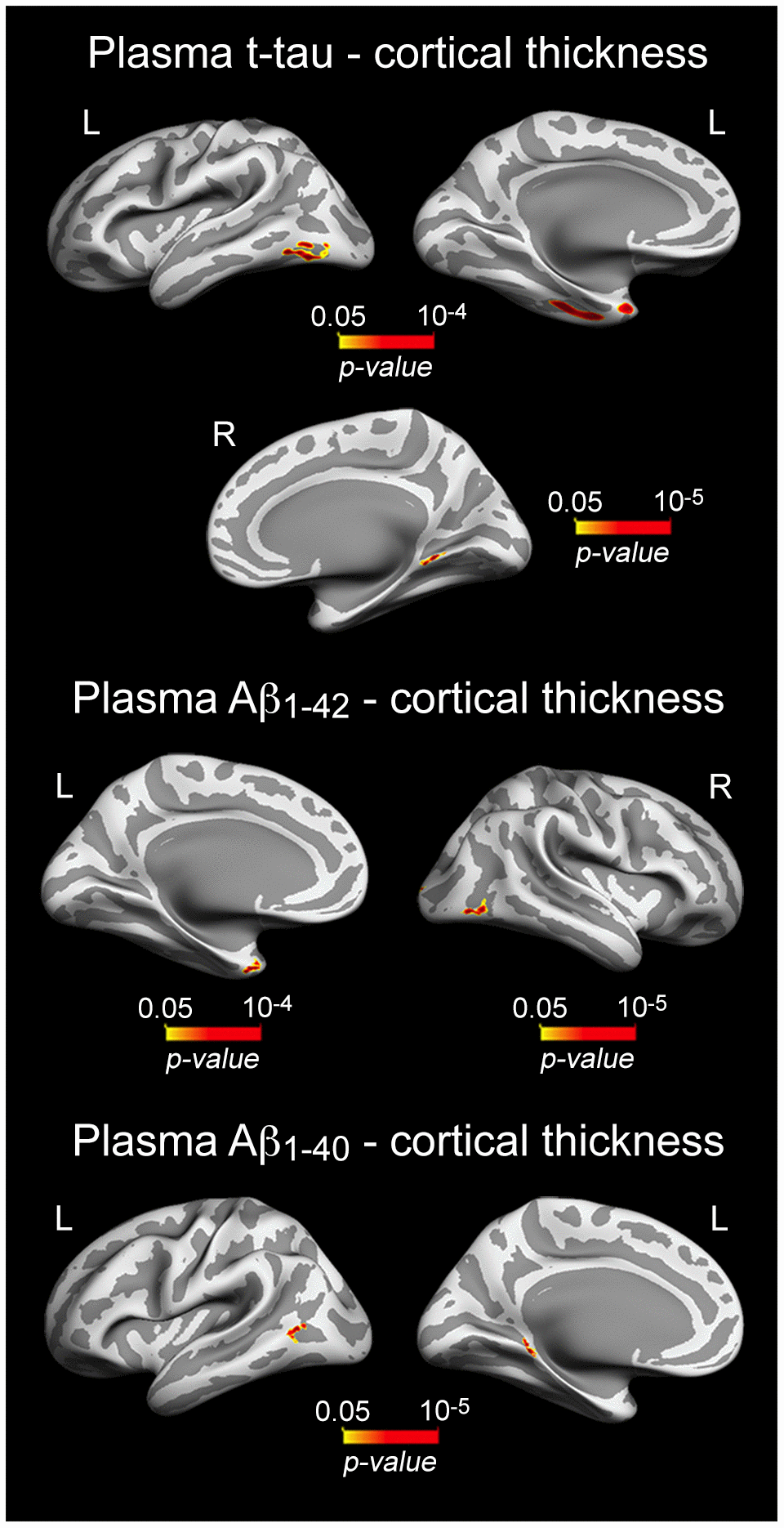 Significant associations between increased plasma t-tau/Aβ1-40/Aβ1-42 and patterns of cortical thinning. Results are represented on inflated cortical surfaces. Left (L) and right (R). The color scale bar illustrates the range of significant p-values.