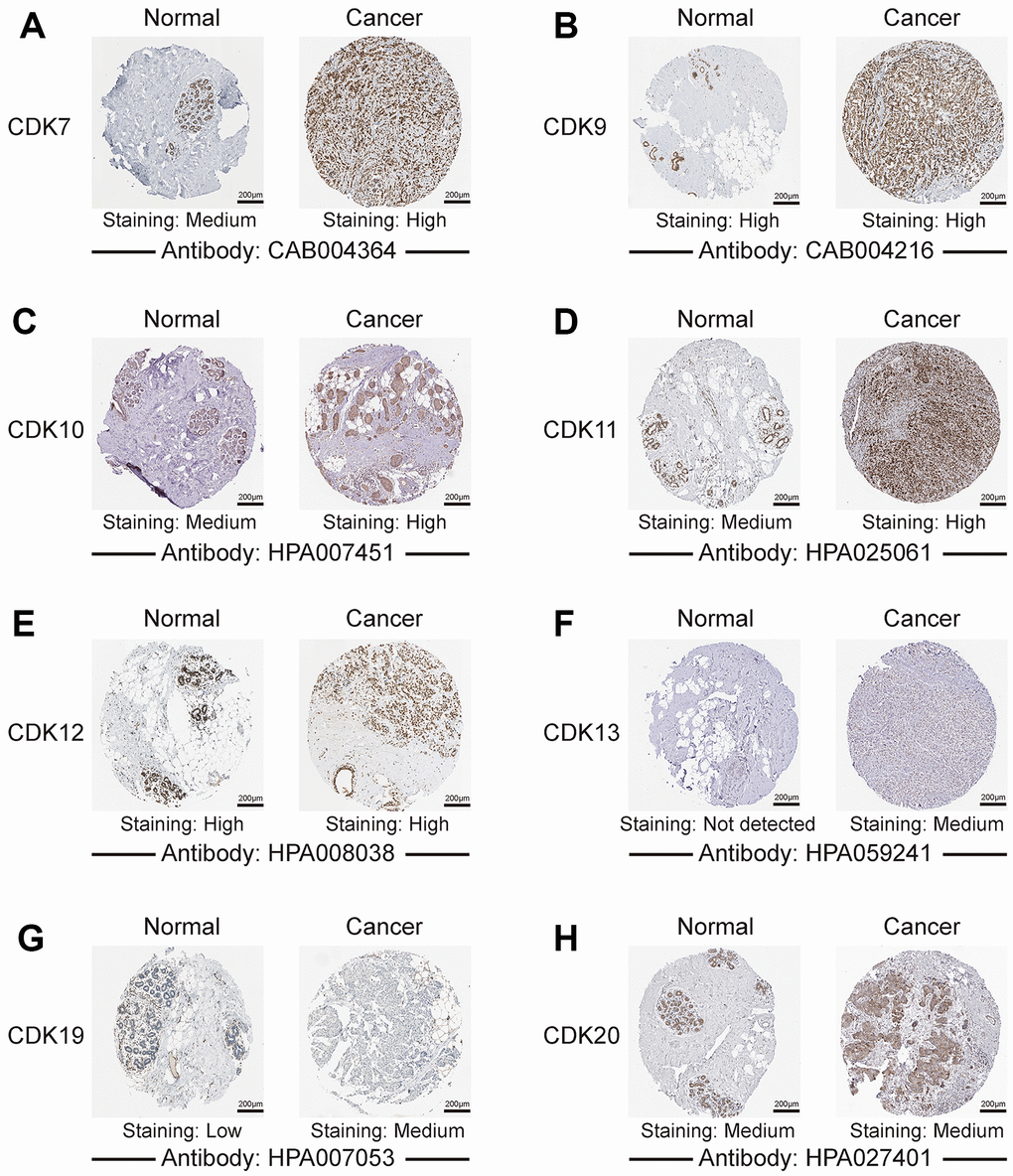 Representative images of TA-CDK immunohistochemistry in normal breast and breast cancer tissues (Human Protein Atlas). (A) CDK7. (B) CDK9. (C) CDK10. (D) CDK11. (E) CDK12. (F) CDK13. (G) CDK19. (H) CDK20.