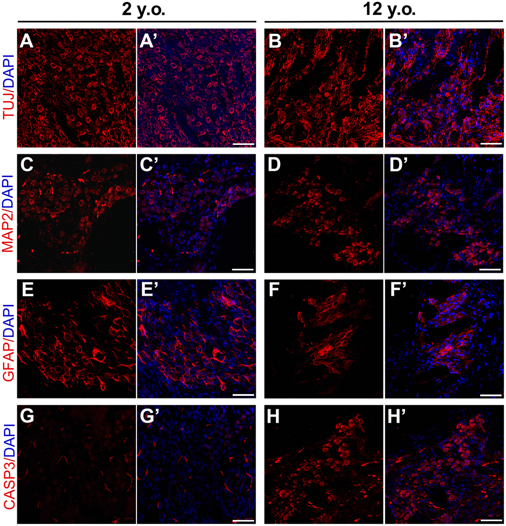 Effects of age on expression patterns of neuronal and glial markers in marmosets. Confocal immunofluorescence images of cryosections of the modiolus regions of 2-year-old and 12-year-old marmosets. SGNs labeled with TUJ in the (A, A’) 2-year-old and (B, B’) 12-year-old marmosets. MAP2 positive neurons in the modiolus of the (C, C’) 2-year-old and (D, D’) 12-year-old marmosets. GFAP2 positive glia were in the (E, E’) 2-year-old and (F, F’) 12-year-old marmosets. Apoptosis was labelled by cleaved Caspase-3 in 2-year-old marmoset (G, G’) and 12-year-old marmoset (H, H’). Scale bar: 50 μm.