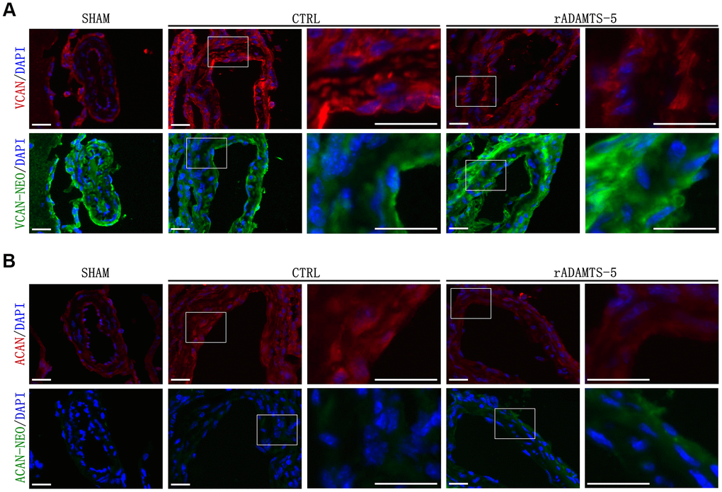 Effects of rADAMTS-5 on proteolysis and detection of the main proteoglycans in IA arteries. Representative immunofluorescence staining images showing (A) versican (VCAN) degradation and (B) aggrecan (ACAN) degradation in IA arteries from sham mice and control (CTRL) mice and in arteries from rADAMTS-5-administered mice. Images in columns 3 and 5 represent higher magnification views of the areas contained within the white boxes in the left-hand columns. Versican and aggrecan are displayed in red, and the neoepitopes of versican and aggrecan are displayed in green. Scale bar: 25 μm.