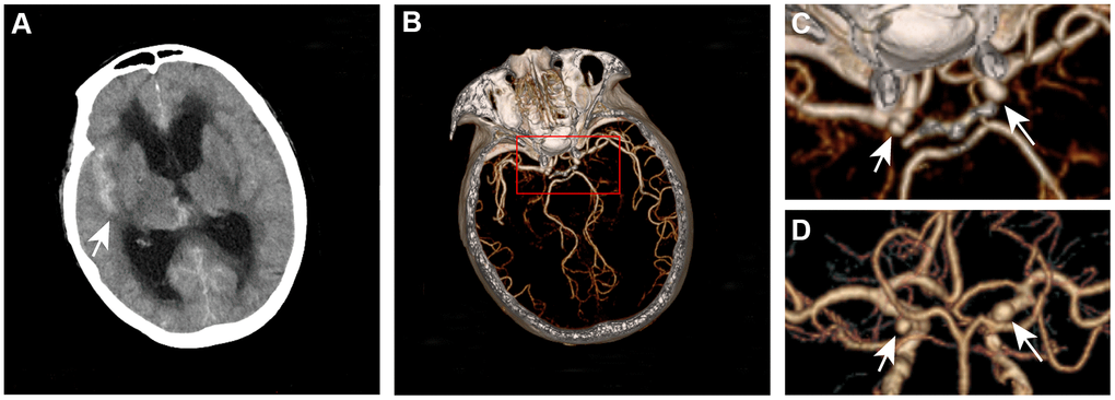 Definitive hemorrhage pattern to confirm the ruptured aneurysm for patients who underwent endovascular or no treatment. A 67-year-old woman presented with subarachnoid hemorrhage (A) was found to have left and right internal carotid aneurysms (B–D). The ruptured aneurysm is the right internal carotid aneurysm.