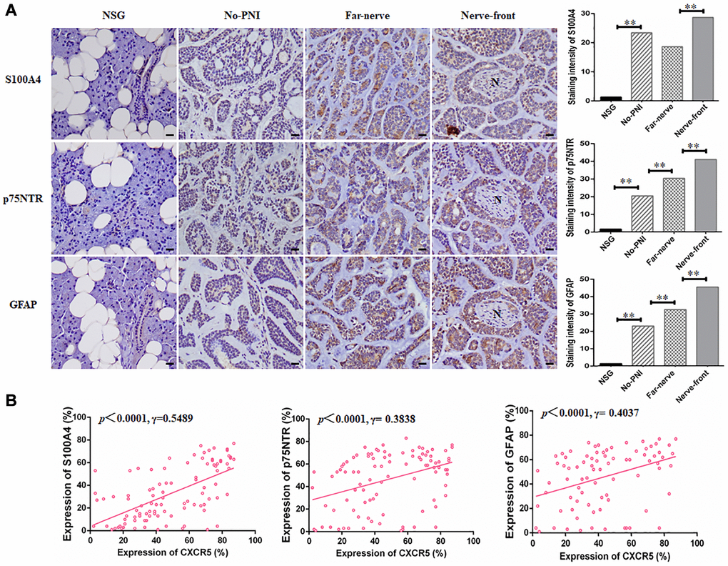 CXCR5 expression intrinsically connects with the level of Schwann cell markers in SACC specimens. (A) Immunohistochemical staining of Schwann cell markers, including S100A4, p75NTR and GFAP in normal salivary gland (NSG), SACC without PNI (No-PNI), far away nerve of SACC with PNI (Far-nerve), nerve invasion front of SACC with PNI (Nerve-front). ‘N’ represented nerve, (Bar: 20 μm). (B) Correlation of CXCR5 with Schwann cell markers at nerve invasion frontier of SACC patients. CXCR5 expression was positively correlated with the expression of S100A4, p75NTR and GFAP at nerve invasion frontier of SACC (**p 