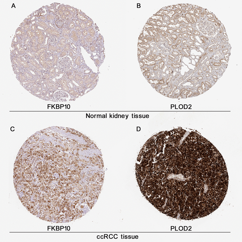 Immunohistochemistry analysis of FKBP10 and PLOD2 in ccRCC. Immunohistochemistry data of FKBP10 and PLOD2 in ccRCC samples and normal kidney tissues from the HPA database. (A) FKBP10 in normal kidney tissue. Antibody HPA057021, patient ID 1859. FKBP10 in glomeruli: staining not detected, weak intensity, quantityB) PLOD 2 in normal kidney tissue. Antibody CAB025898, patient ID 1933. PLOD2 in glomeruli: low staining, moderate intensity, quantity75%, membranous. (C) FKBP 10 in ccRCC tissue. Antibody HPA057021, patient ID 3039. FKBP10 in ccRCC tissue: high staining, strong intensity, quantity>75%, located in cytoplasmic/membranous. (D) PLOD2 in ccRCC tissue. Antibody CAB025898, patient ID 2564. PLOD2 in ccRCC tissue: high staining, strong intensity, quantity>75%, located in cytoplasmic/membranous.