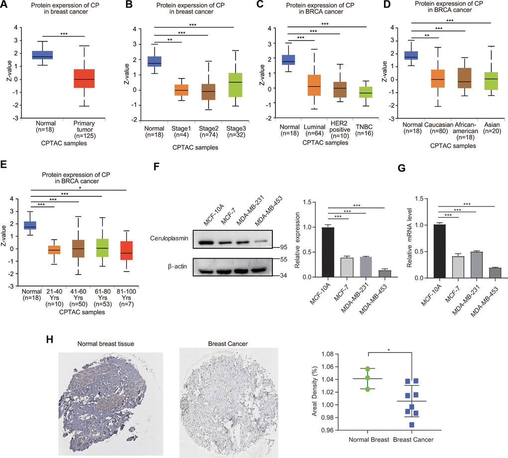 Ceruloplasmin protein levels in BRCA. (A) Ceruloplasmin protein levels in BRCA tissues and normal breast tissues were investigated based on the CPTAC database. (B–E) Relationship between ceruloplasmin protein expression and clinicopathological parameters of BRCA patients, including individual cancer stage, major subclass, patient race and age. (F) The protein levels of ceruloplasmin in MCF-10A, MDA-MB-231 and MCF-7 cells were investigated by western blotting. (G) The mRNA levels of ceruloplasmin in three different cell lines were examined by real-time PCR. (H) Representative IHC images of ceruloplasmin in normal breast tissues (upper) and BRCA (lower) were shown. The staining was quantified (normal breast tissue, n=3; BRCA, n=8). One-way ANOVA was used. *