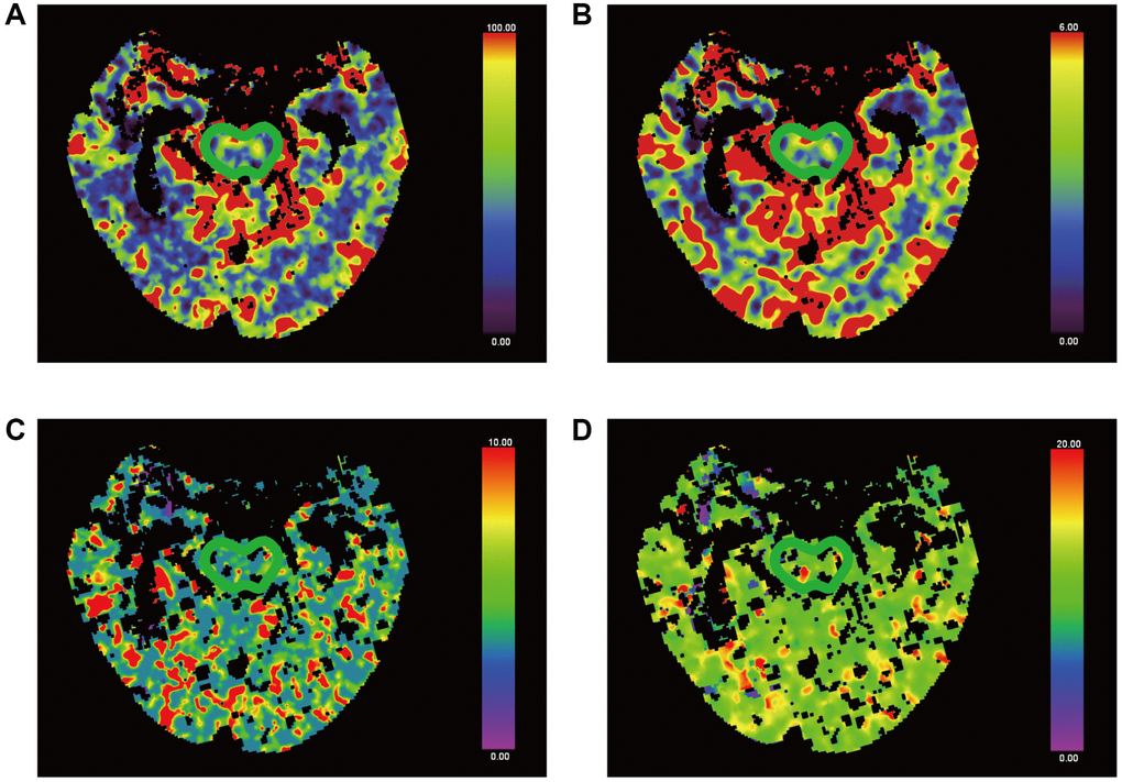 False-colour pictures of a 76-year-old MCS− man after right thalamus hemorrhage at the pontine level. The affected side is right. (A) The CBF map of the brainstem, (B) the CBV map, (C) the TTP map and (D) the MTT map.
