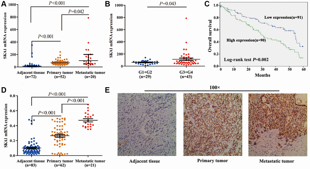 High SKA1 expression positively correlates with human renal cancer progression. (A–C), Analysis of SKA1 mRNA expression in ccRCC samples from TCGA-KIRC. (A) Analysis on SKA1 mRNA levels among ccRCC tissues, paired normal tissues, and metastatic tumor tissues (N = 72). (B) Analysis on SKA1 mRNA levels in low Fuhrman grade (G1+G2) and advanced-grade (G3+G4). (C) Kaplan–Meier analysis of ccRCC patient survival. (D) Analysis on SKA1 mRNA levels among ccRCC tissues, paired normal tissues, and metastatic tumor tissues (N = 83). (E) Representative images of IHC staining (magnification, ×100) for SKA1 protein from 83 ccRCC specimens.