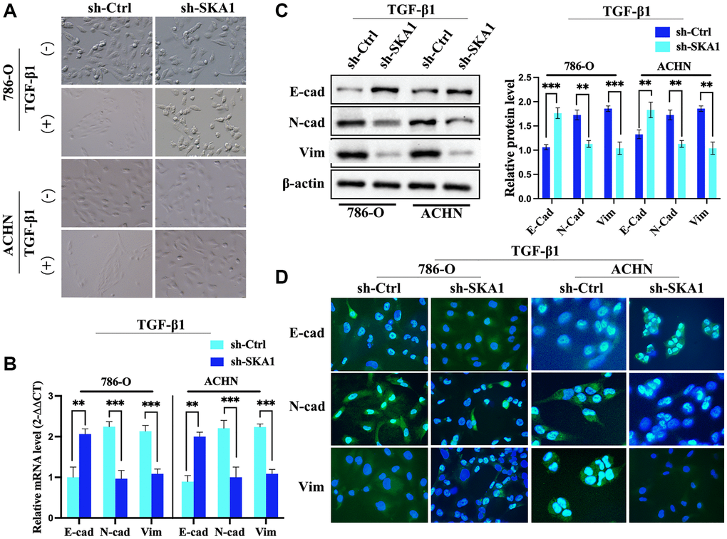 SKA1 silencing blocks TGF-β1-induced EMT in ccRCC cells. (A) Morphological analysis of 786-O and ACHN cells infected with control (sh-Ctrl) or SKA1 shRNA (sh-SKA1) with or without TGF-β1 treatment. Scale bar = 60 μm. (B) qPCR analysis of E-cadherin (E-cad) and vimentin mRNA levels in 786-O and ACHN cells infected with indicated constructs after TGF-β1 treatment. Mean fold change was calculated from three independent experiments performed in triplicate, with respect to sh-Ctrl-transfected cells artificially set by one. *P C) Western blot analysis of E-cad and vimentin protein levels in 786-O and ACHN cells. One representative experiment of three independent experiments are shown. Numbers indicate fold change in protein levels. (D) Immunofluorescence analysis of E-cad, N-cad and vimentin. Scale bar = 20 μm.