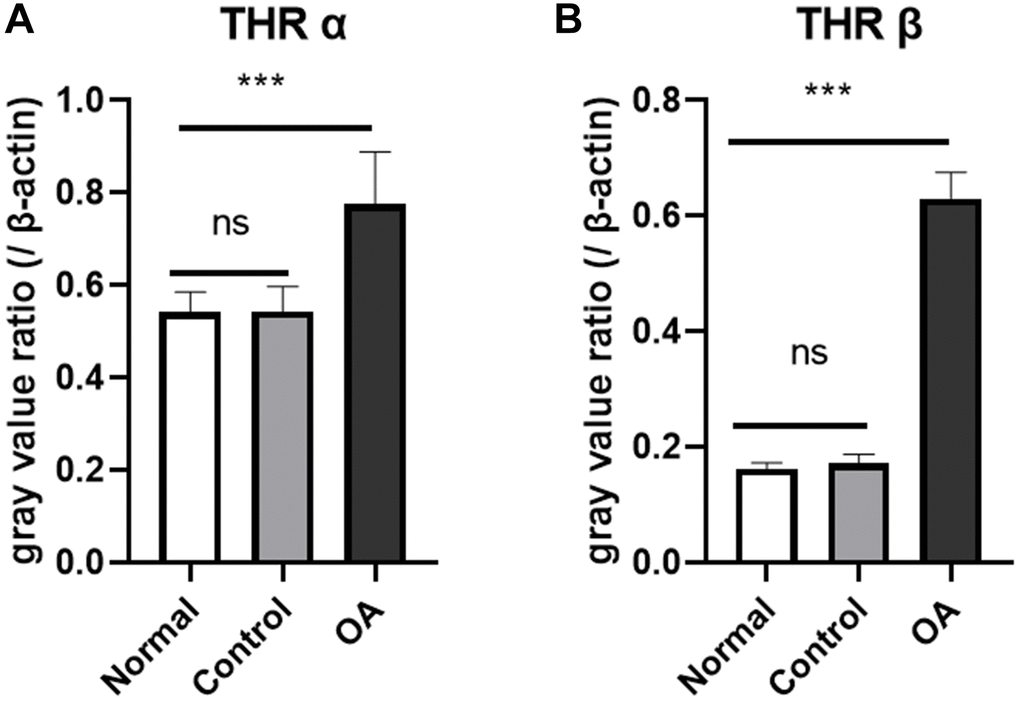 Expression of thyroid hormone receptor gene in the hippocampus of mice. The results of real-time quantitative PCR showed that the expression of thyroid receptor gene THRα (A) and THR β (B) was higher in the okadaic acid (OA) treated group than that in the control group at 2 weeks after injection (****P P = 0.650 and 0.924, respectively). Normal: Mice without stereotactic puncture; control: The mice were punctured stereotaxically and injected with 5 μL of normal saline; OA: Mice were subjected to stereotactic puncture and injection of 5 μL of 0.1 μM okadaic acid. (LSD test, n = 6).